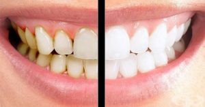 come rimuovere placca dentale